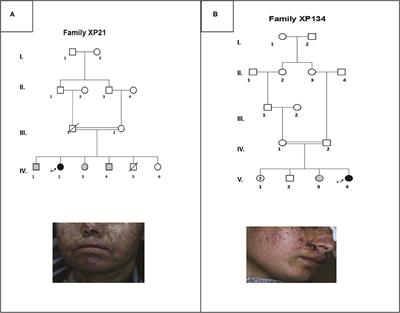 Case Report: Identification of Novel Variants in ERCC4 and DDB2 Genes in Two Tunisian Patients With Atypical Xeroderma Pigmentosum Phenotype